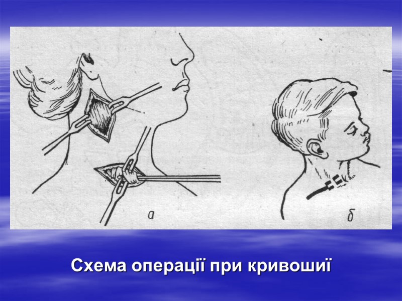 Схема операції при кривошиї